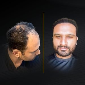 HT Before & After (1)