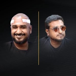 HT Before & After (2)